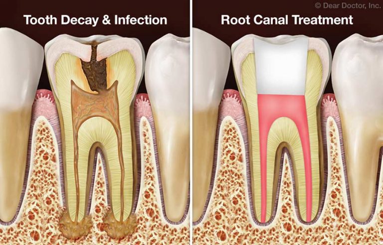 Root Canal Therapy (Endodontics) - Green Apple Dentistry